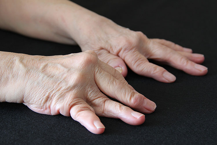 リウマチ膠原病内科画像